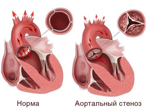 артериальный стеноз