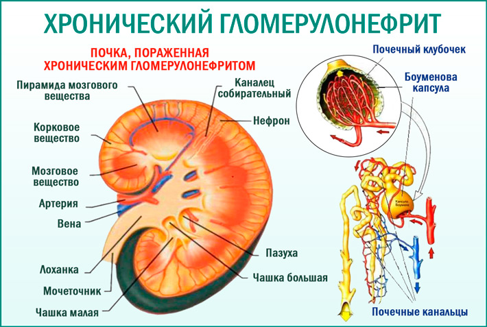 Хронический гломерулонефрит: симптомы