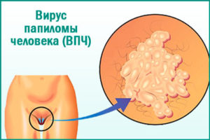 Вирус папилломы человека и рак шейки матки