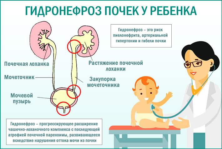 Гидронефроз у детей и новорожденных
