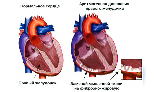 Аритмогенная кардиомиопатия