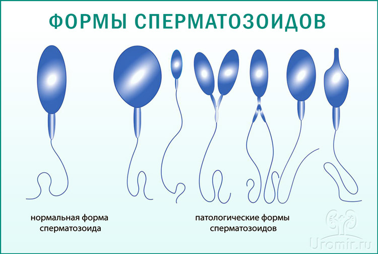 Здоровые и патологические формы сперматозоидов