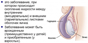 Классификация гидроцеле яичка