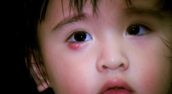 Почему у ребенка постоянно выскакивает ячмень на глазу?