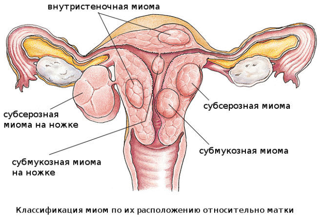Аденомиома в полости матки
